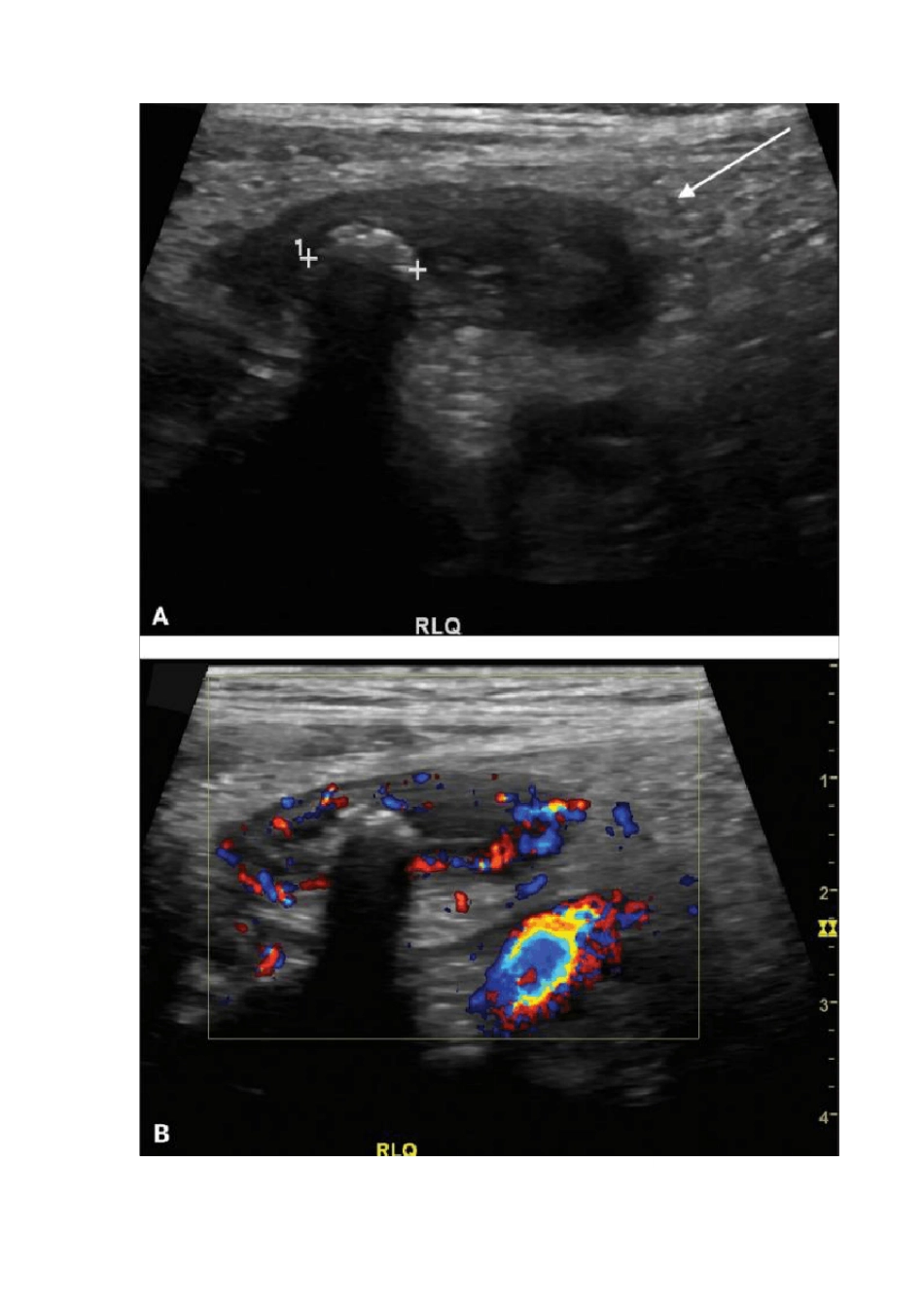 儿童腹痛超声诊断_第3页