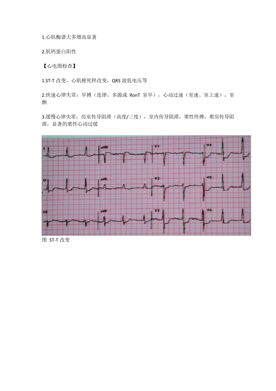 爆发性心肌炎_第2页