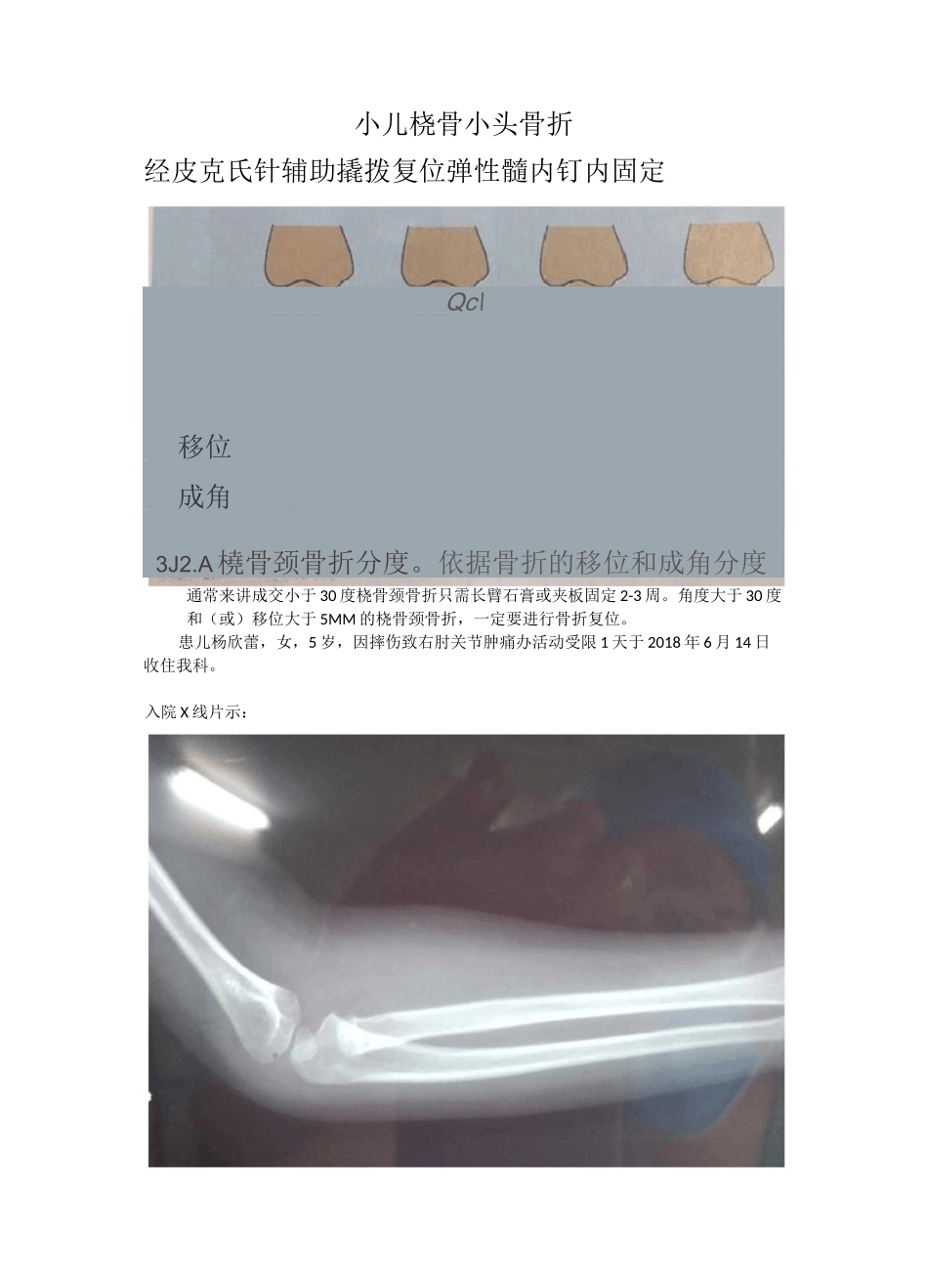 小儿桡骨小头骨折_第1页