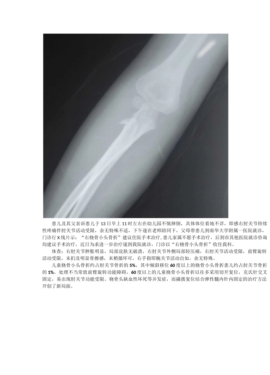 小儿桡骨小头骨折_第2页