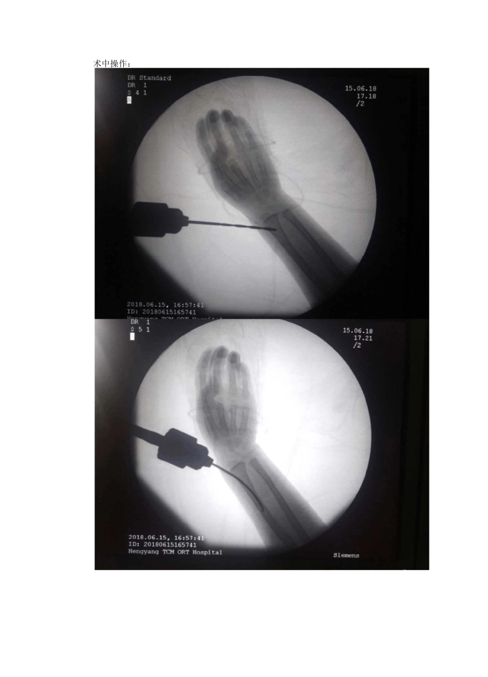 小儿桡骨小头骨折_第3页
