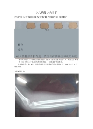 小儿桡骨小头骨折