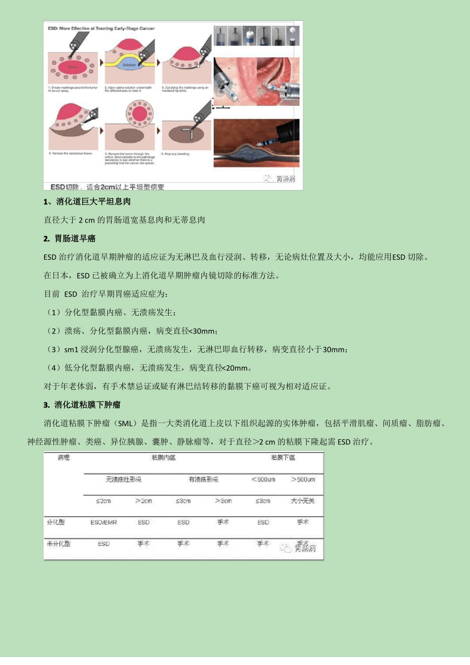 内镜粘膜下剥离术ESD_第2页