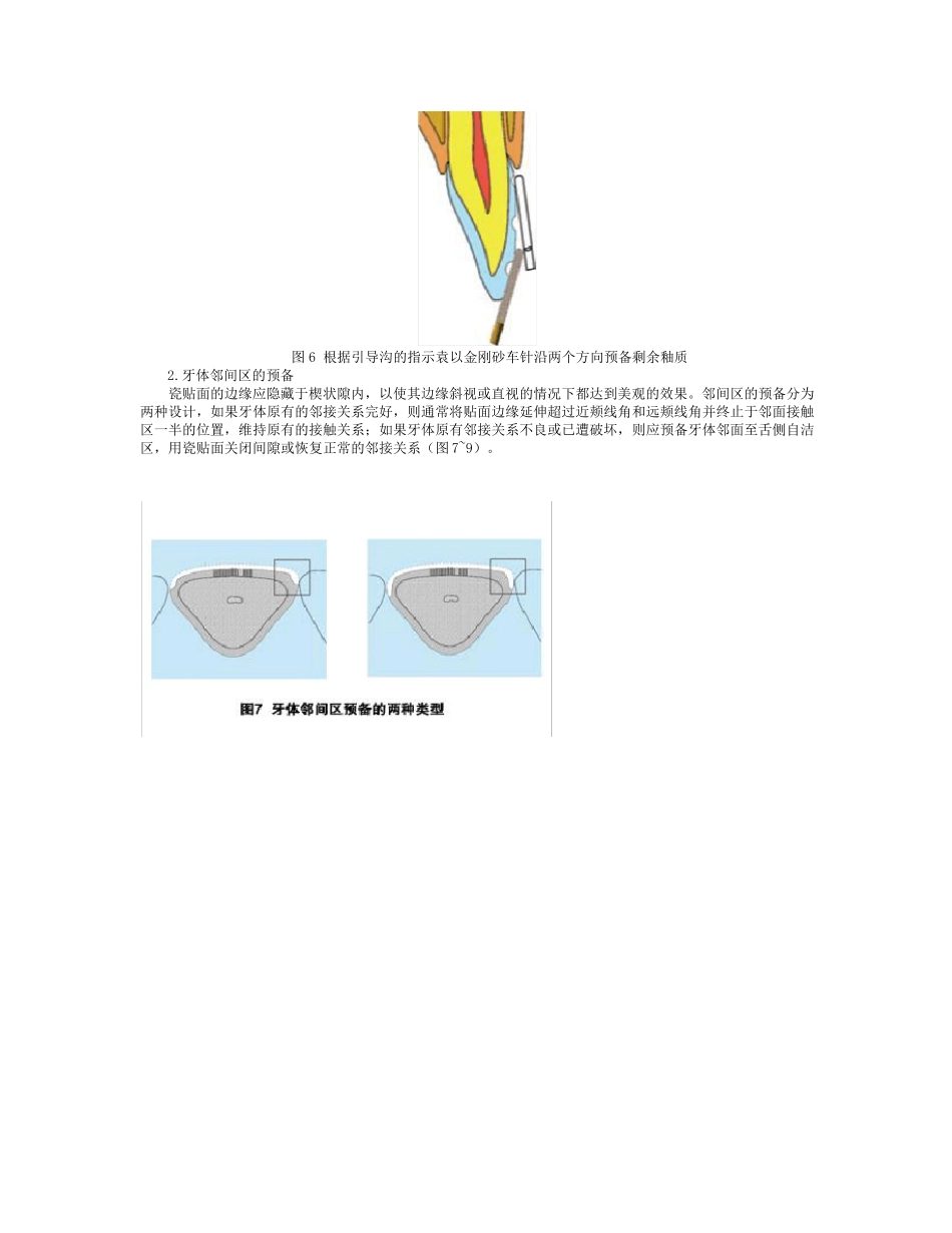 瓷贴面修复牙体预备中的操作要点_第3页