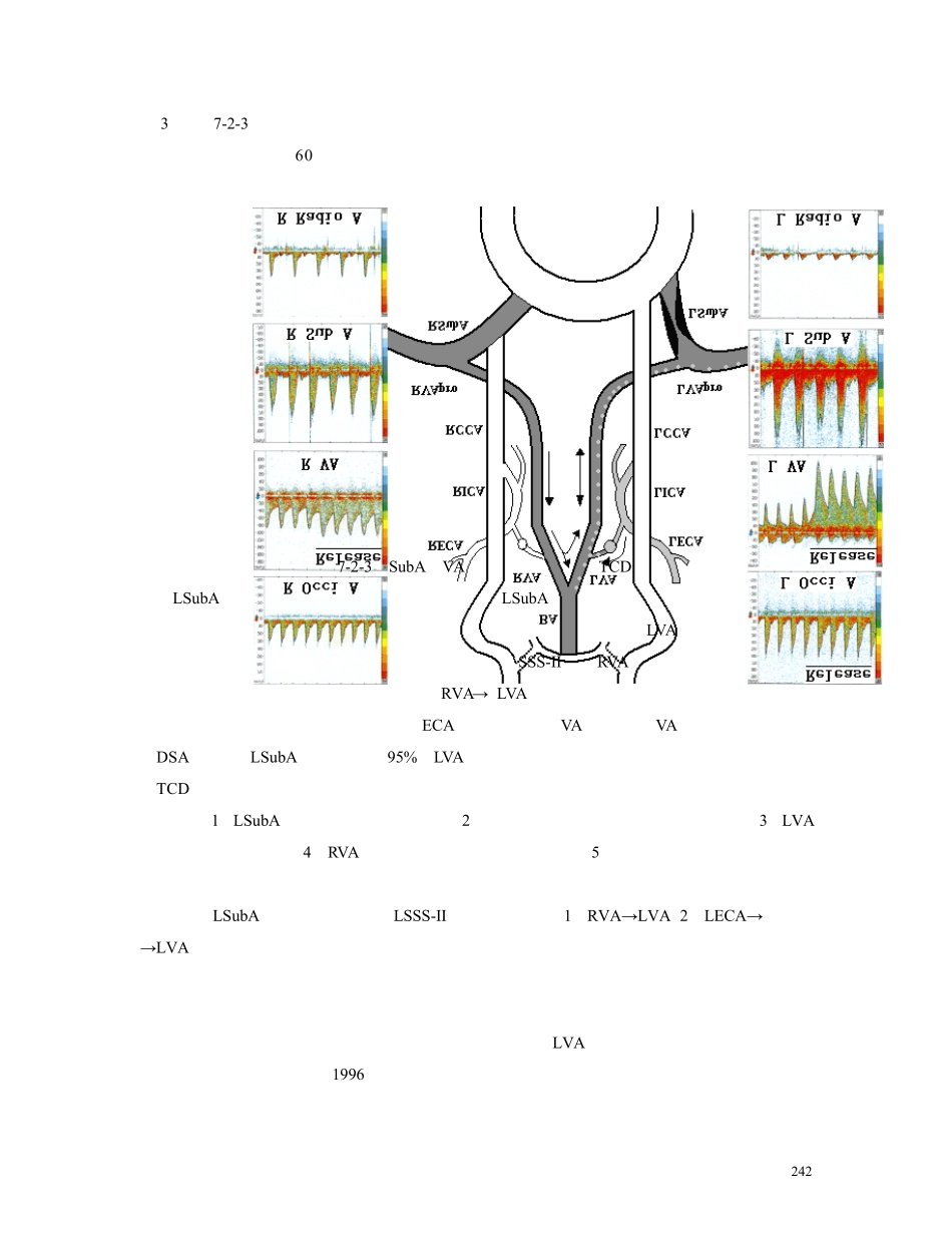 第七章第二节锁骨下动脉盗血综合征的实例分析和TCD报告书写_第3页
