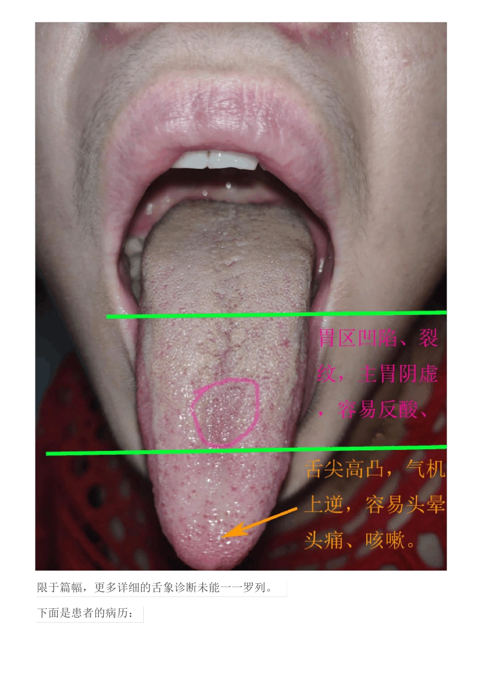 周氏五行全息舌诊技术推广之咳嗽医案分享审核版_第3页