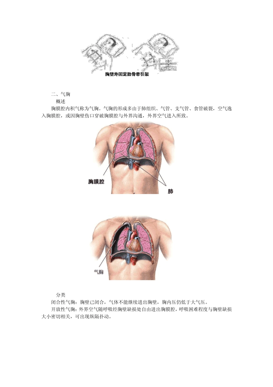 第三章病例分析——胸部闭合性损伤_第3页