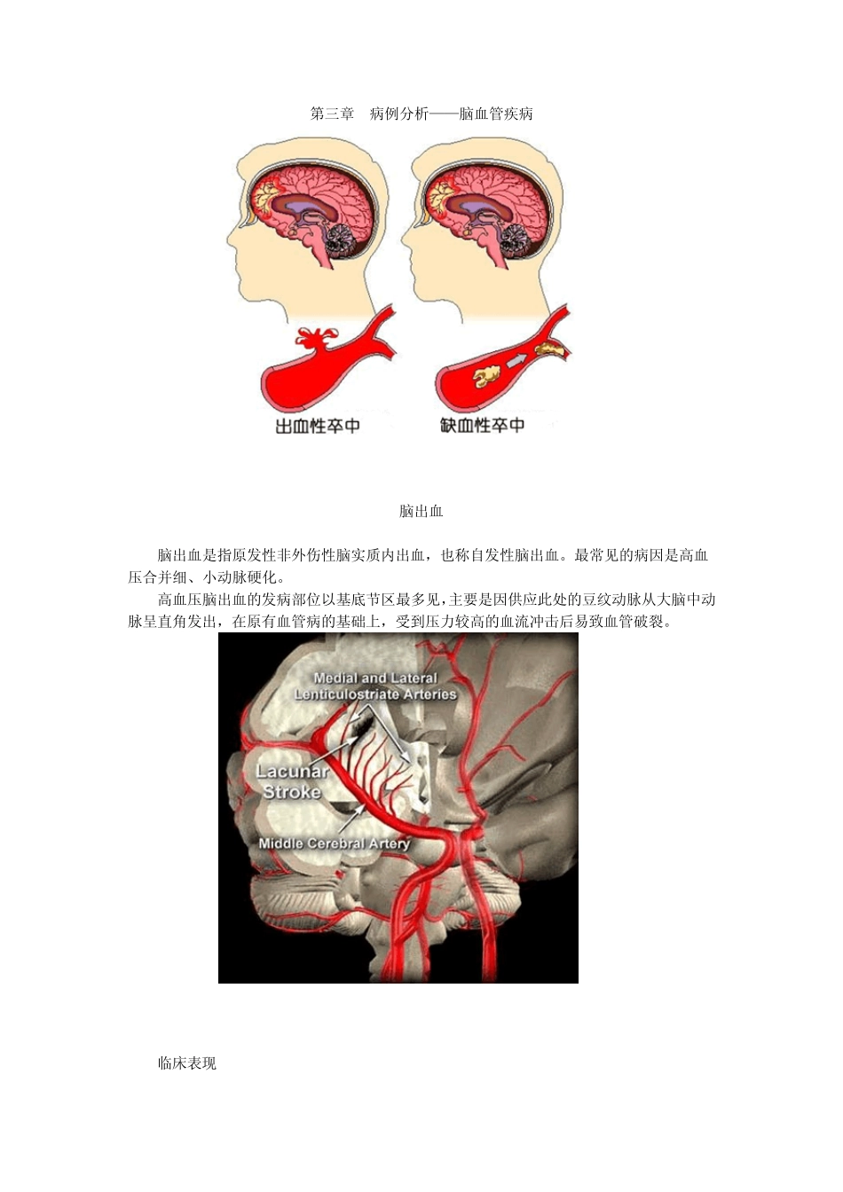 第三章病例分析——脑血管疾病_第1页