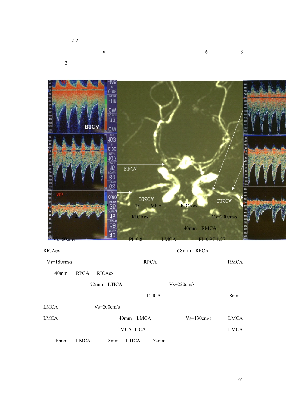 第五章第二节颅内血管狭窄和闭塞实例分析1_第2页