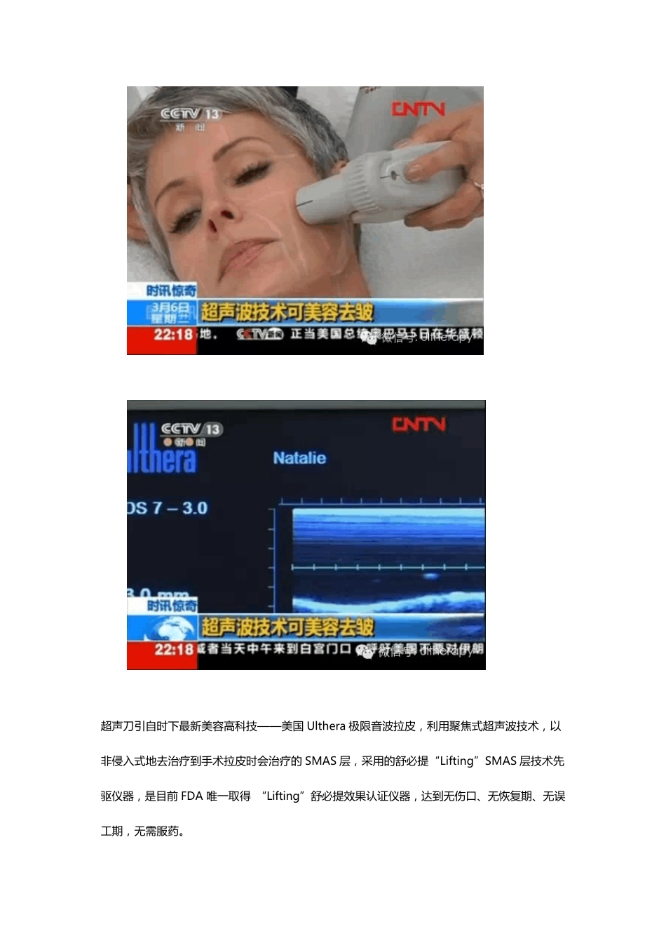 美国Ulthera极限音波拉皮_第2页