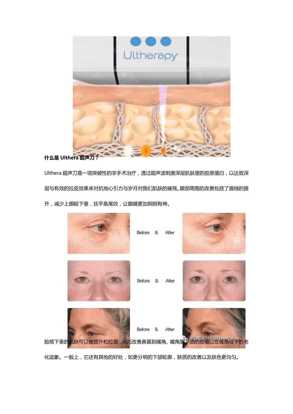 美国Ulthera极限音波拉皮_第3页