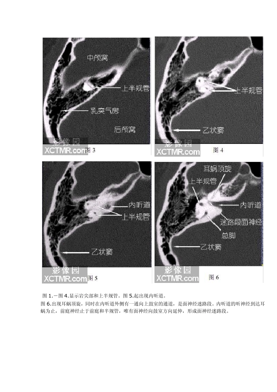 耳部颞骨轴位(水平位)HRCT解剖_第2页
