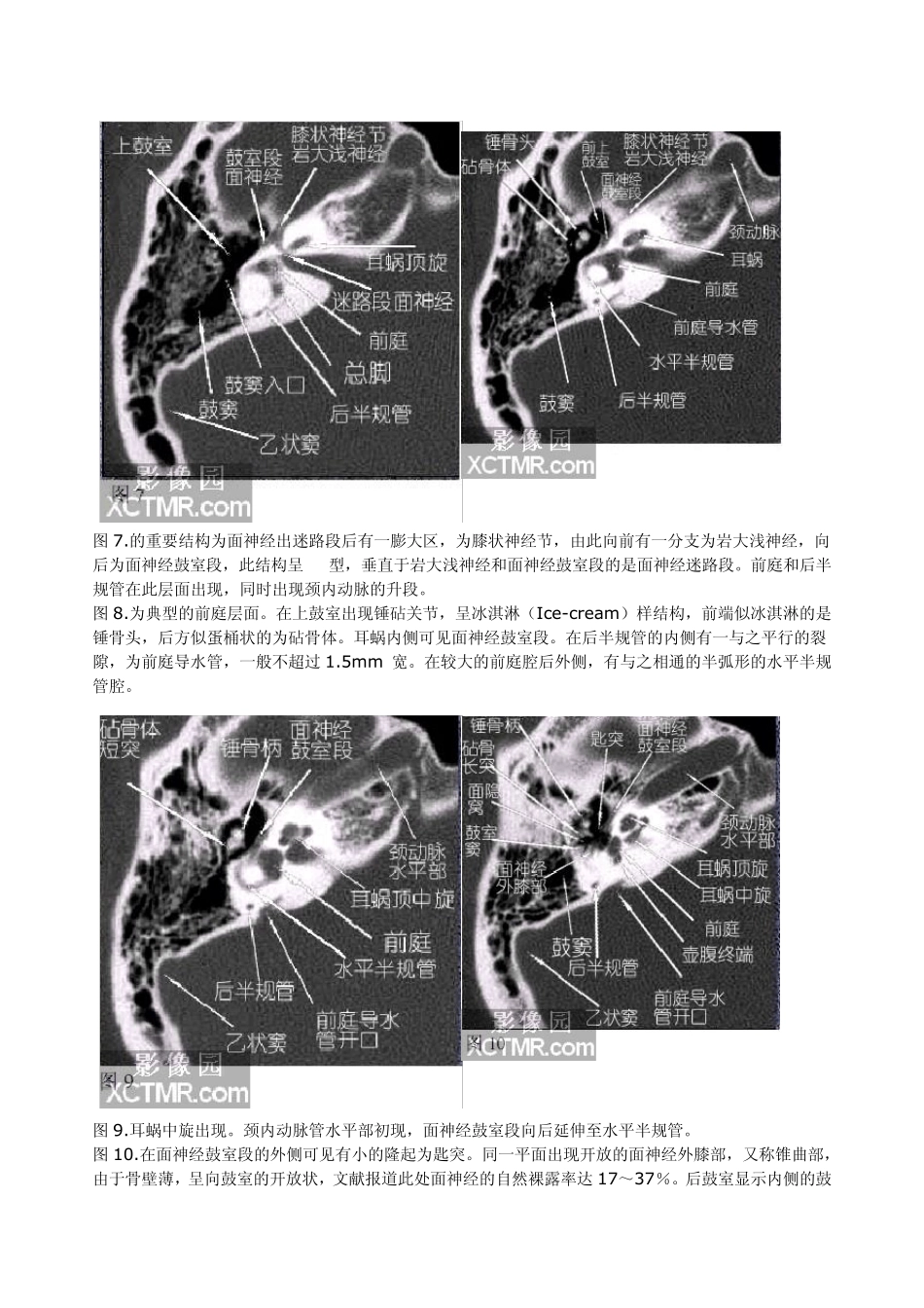 耳部颞骨轴位(水平位)HRCT解剖_第3页