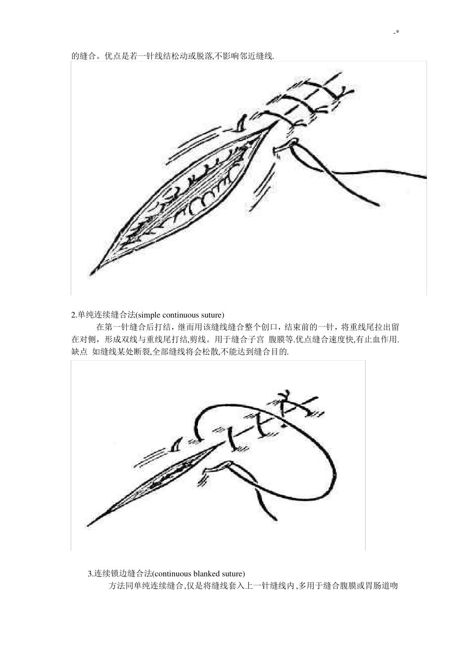 外科缝合的步骤和方法及剪线的基本方法_第2页