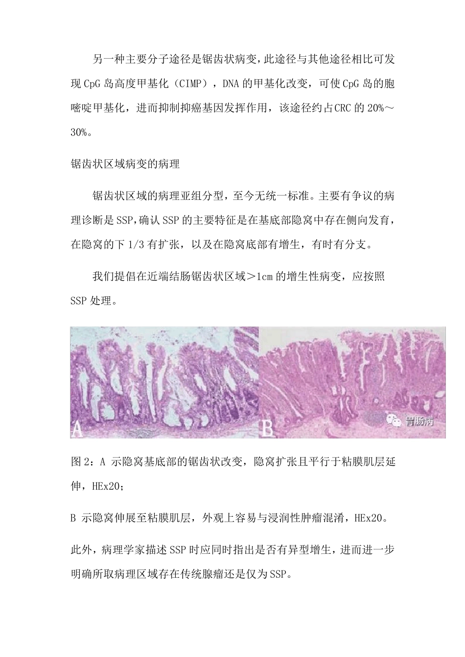 大肠锯齿状病变梳理_第3页