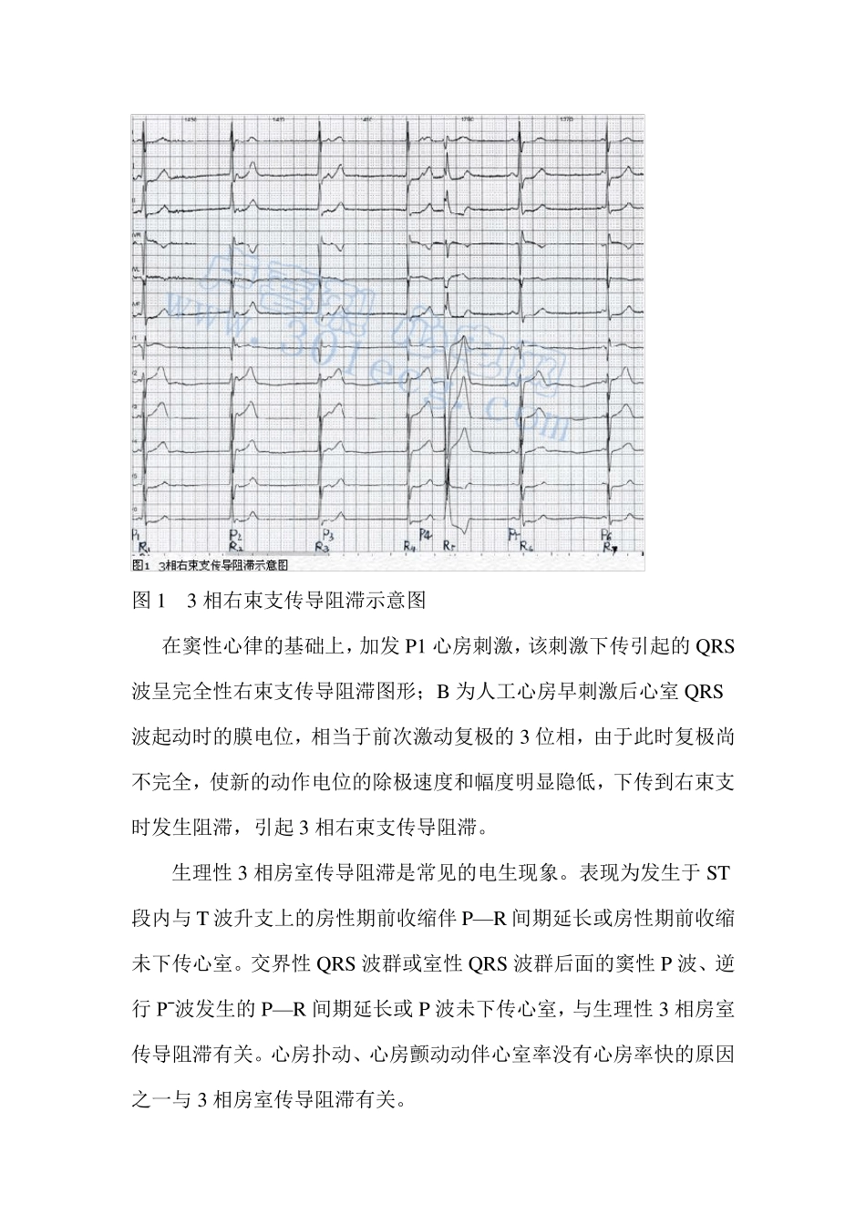 3相传导阻滞_第3页