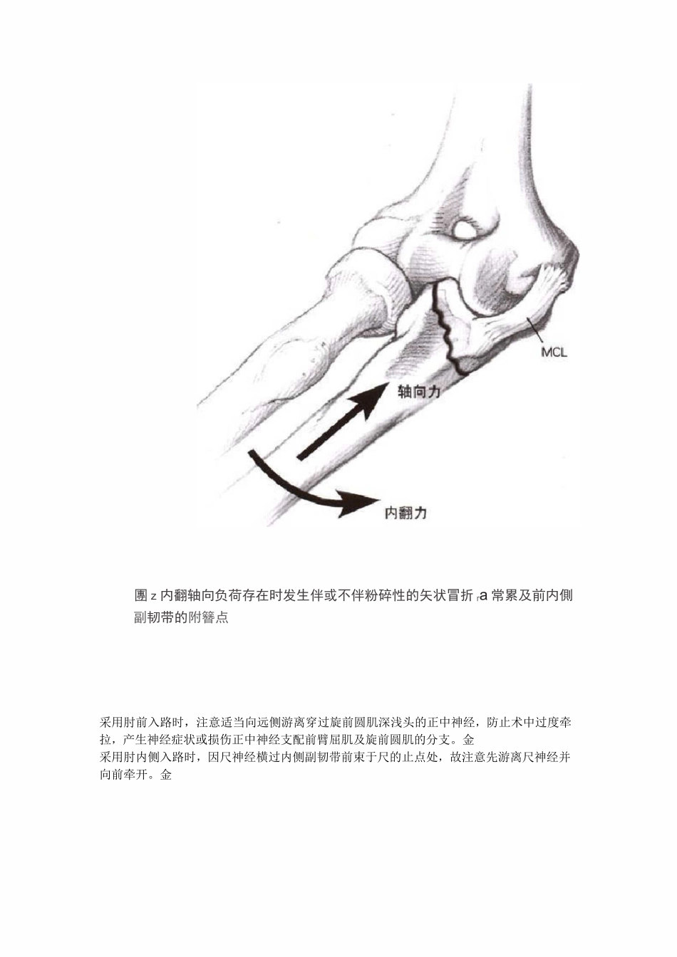 尺骨冠突骨折的分型及治疗_第3页