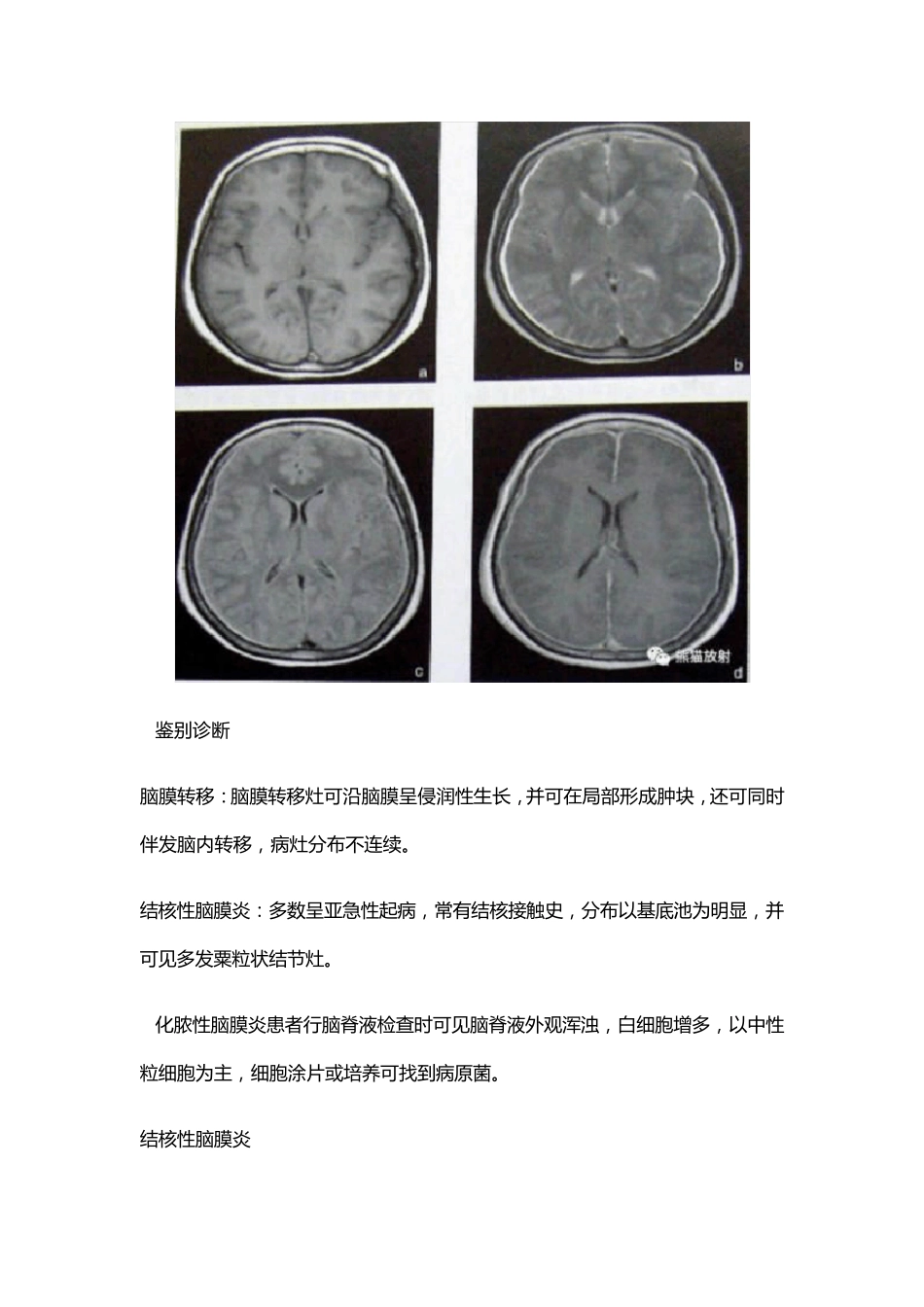 7种颅内感染_第2页