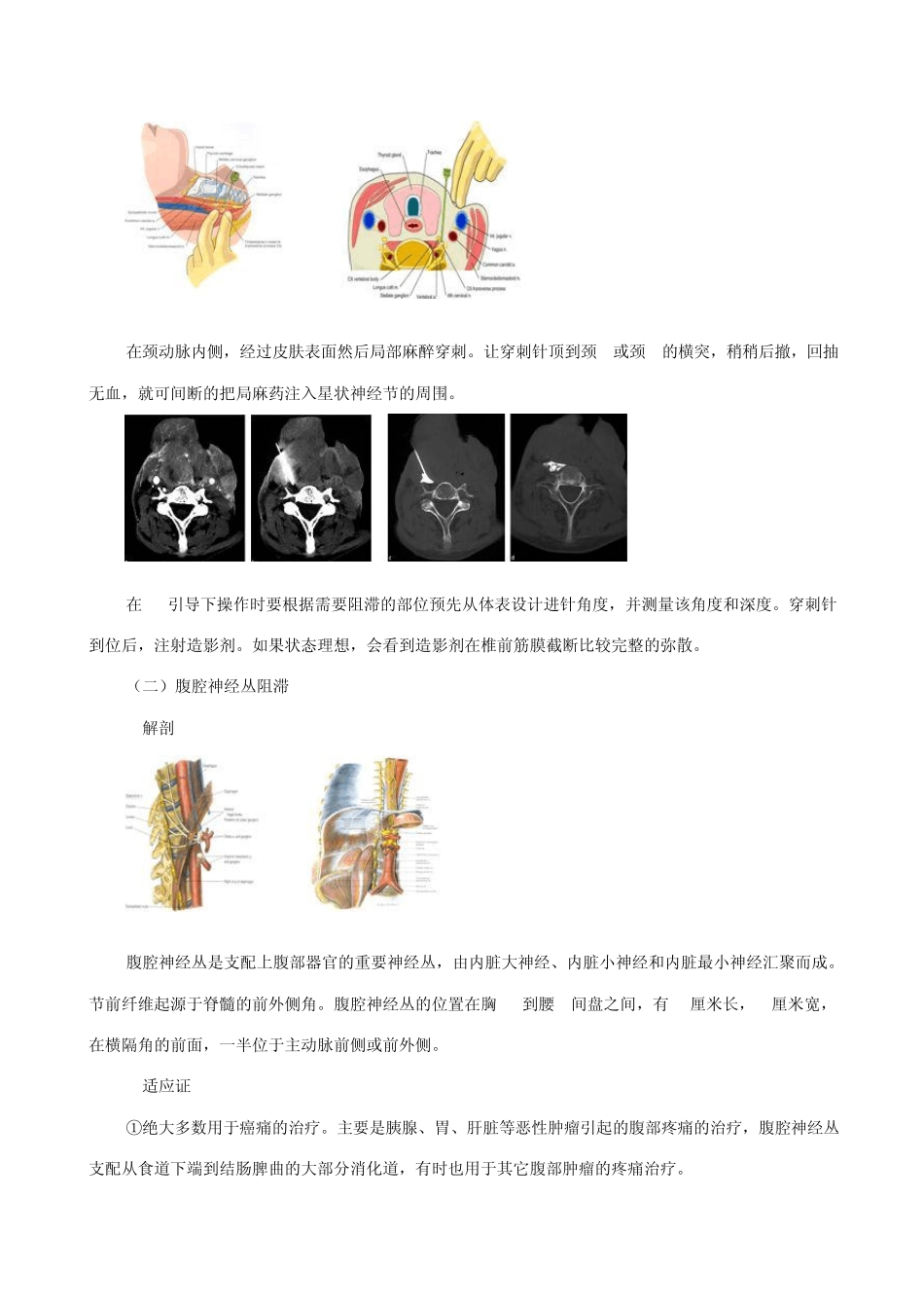 Ct引导下的疼痛介入治疗_第2页