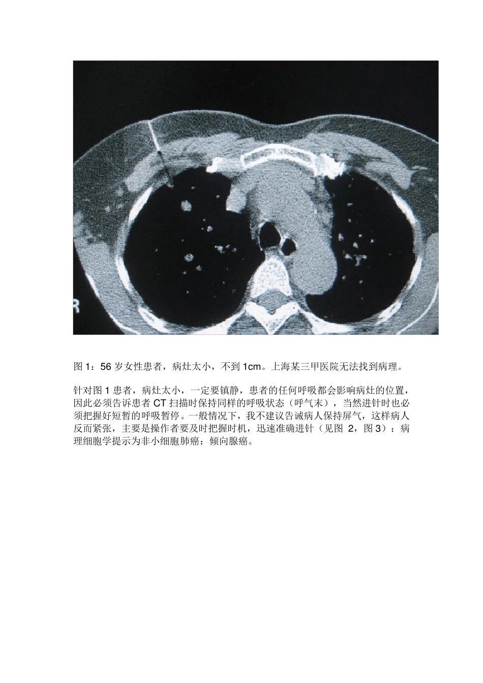 CT引导下经皮肺穿刺的几点心得_第2页