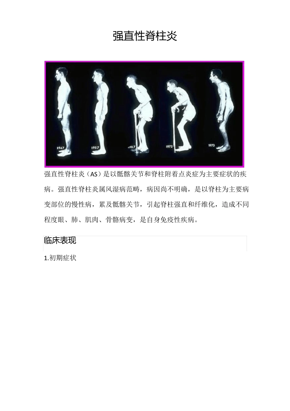 强直性脊柱炎_第1页
