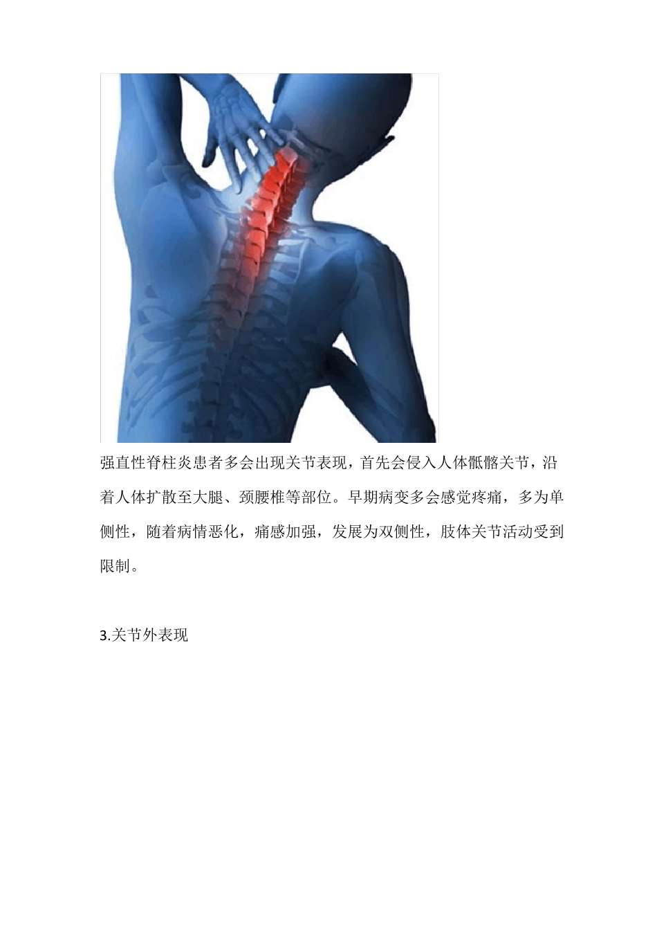 强直性脊柱炎_第3页