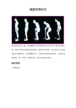 强直性脊柱炎