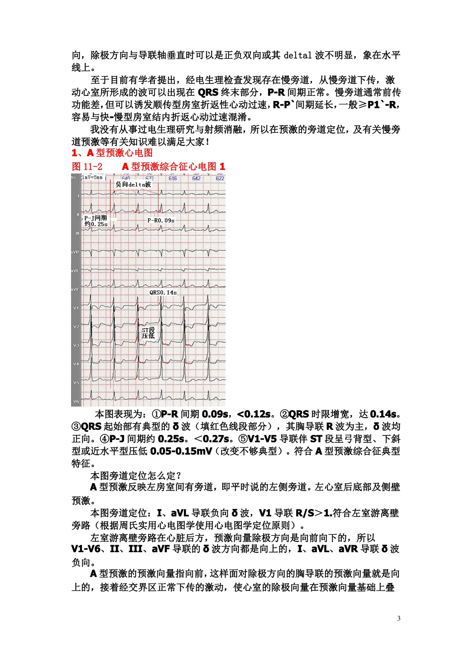 心电图讲义预激症候群_第3页