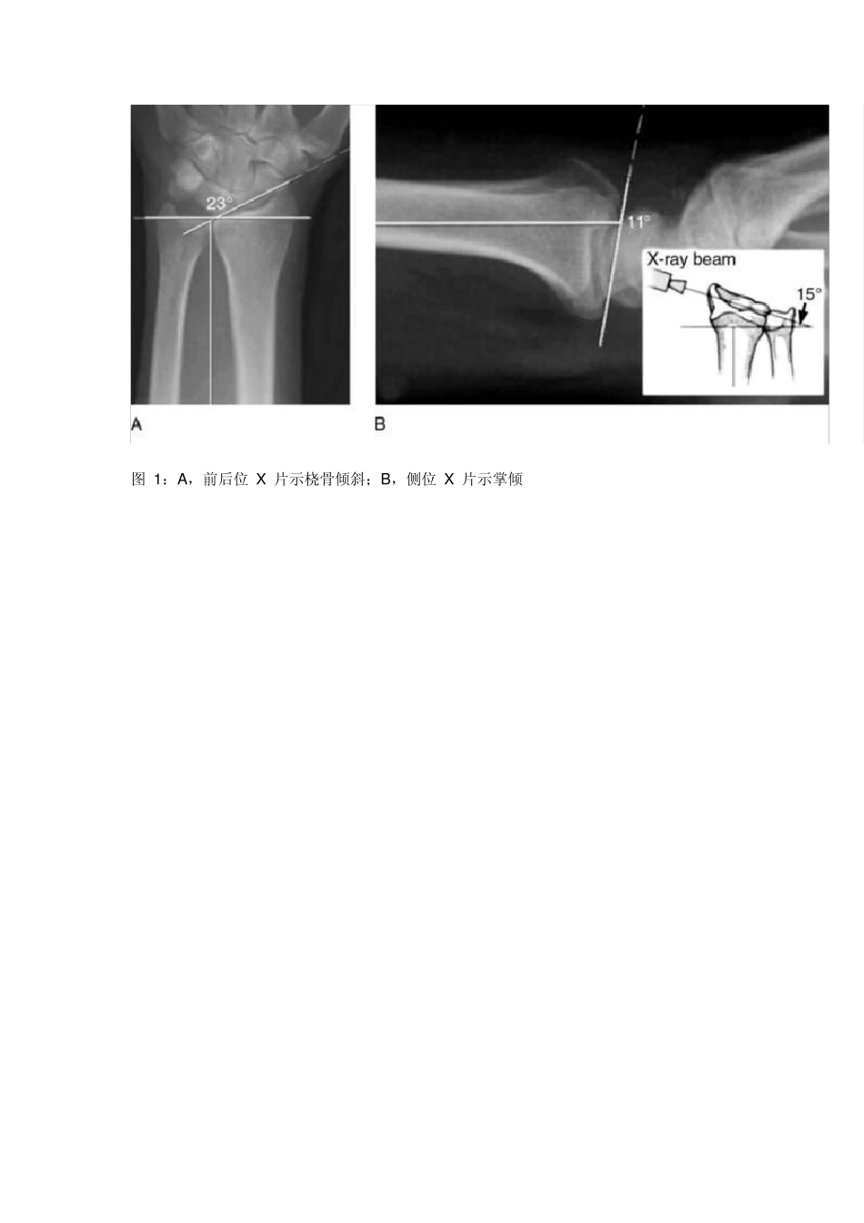 JAAOS综述：桡骨远端骨折治疗争议_第2页