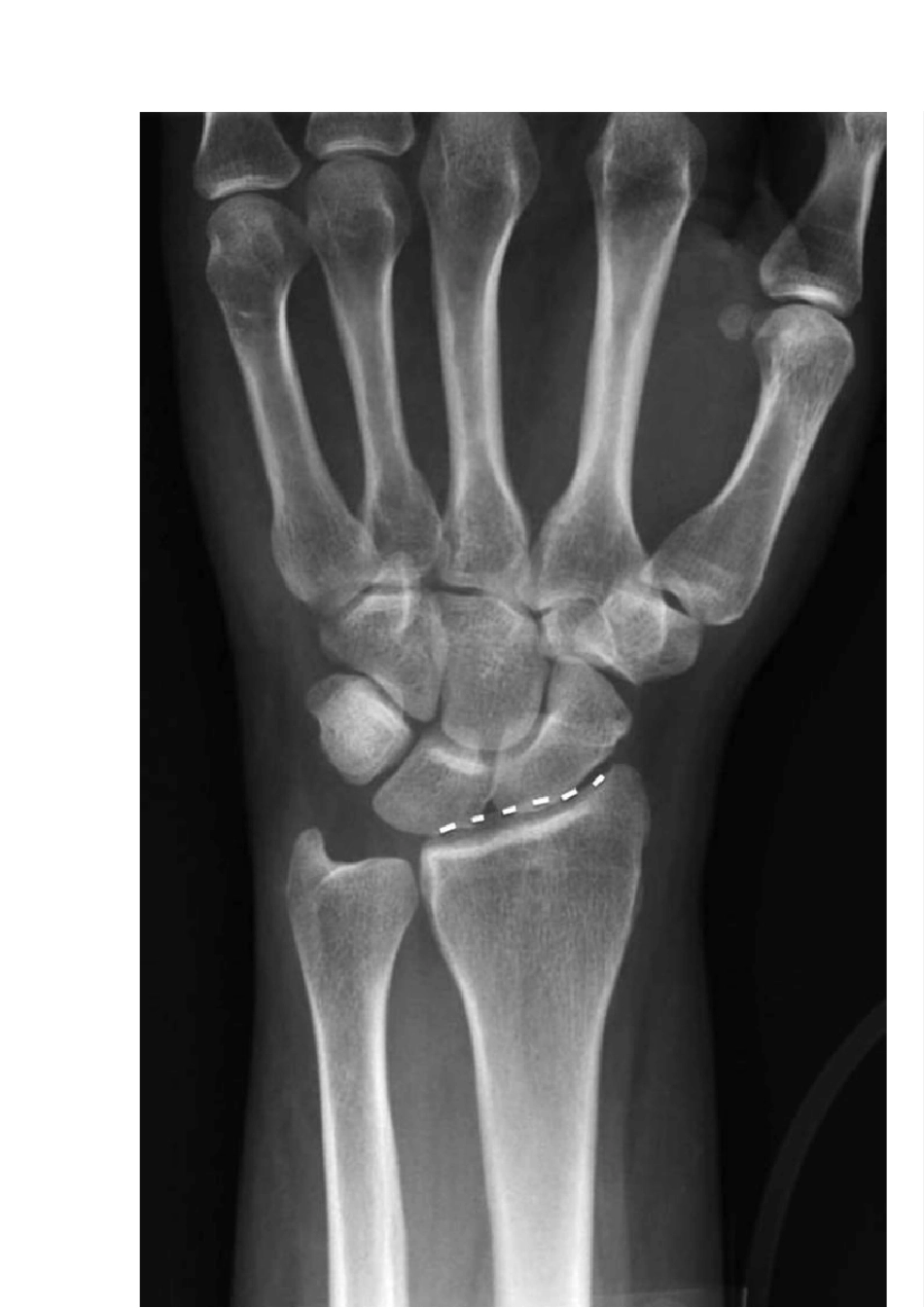 JAAOS综述：桡骨远端骨折治疗争议_第3页