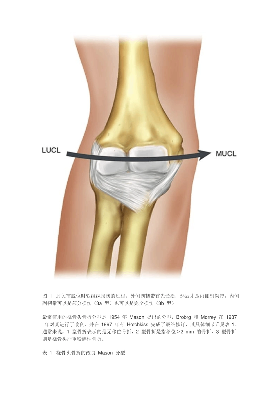 成人肘关节骨折脱位的治疗_第2页