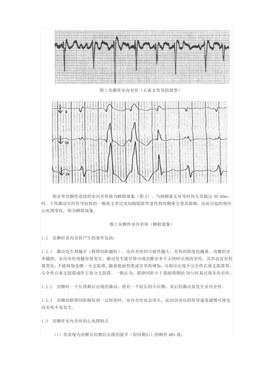 房颤时室早及室内差传的特点与鉴别_第2页