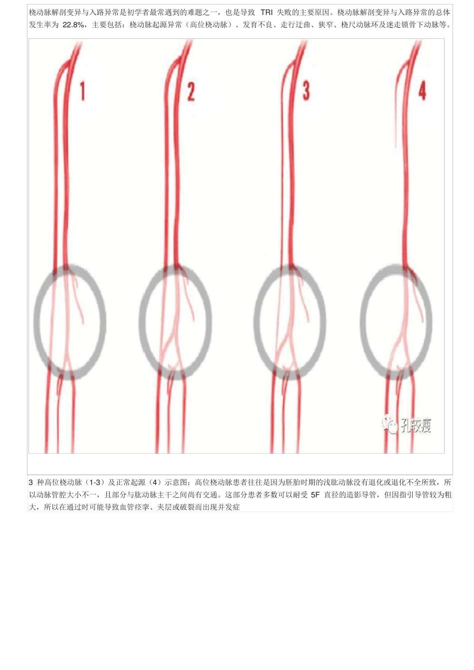 手把手教你桡动脉穿刺技巧精美图文_第2页