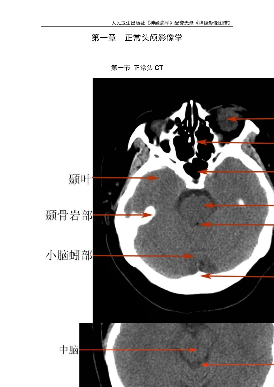 《神经病学》八年制教材_影像图谱_第2页