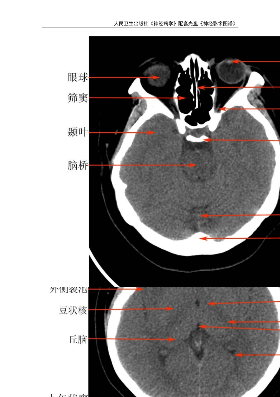 《神经病学》八年制教材_影像图谱_第3页