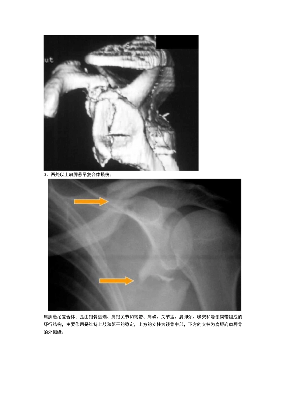 肩胛骨骨折的内固定手术技巧_第2页