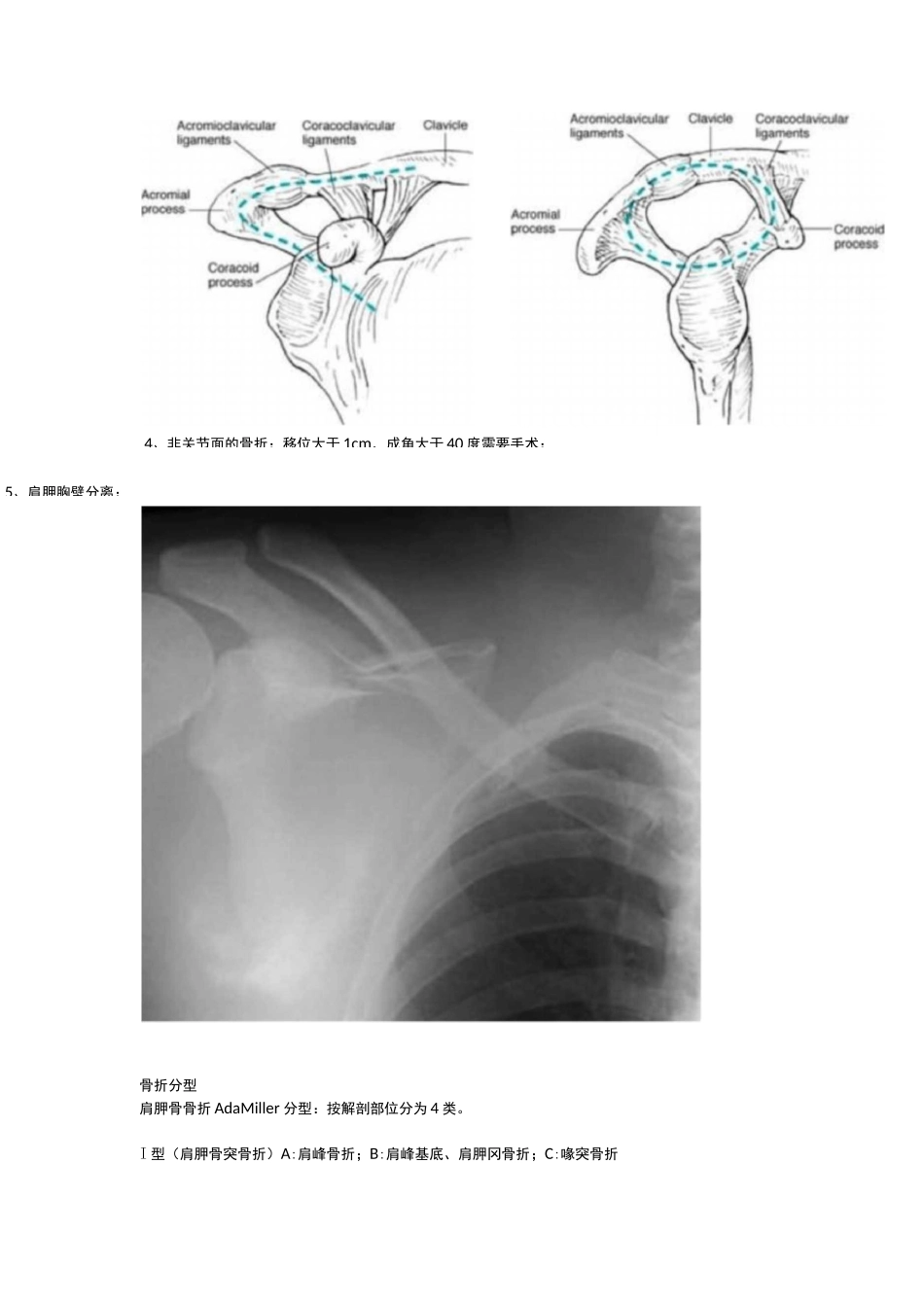 肩胛骨骨折的内固定手术技巧_第3页