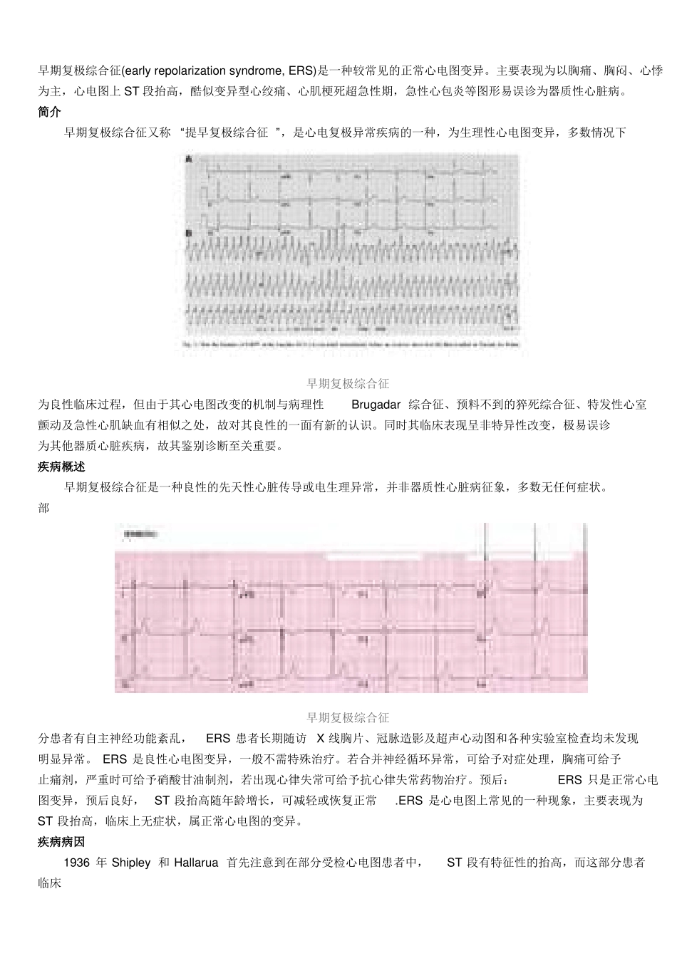 早期复极综合症_第1页