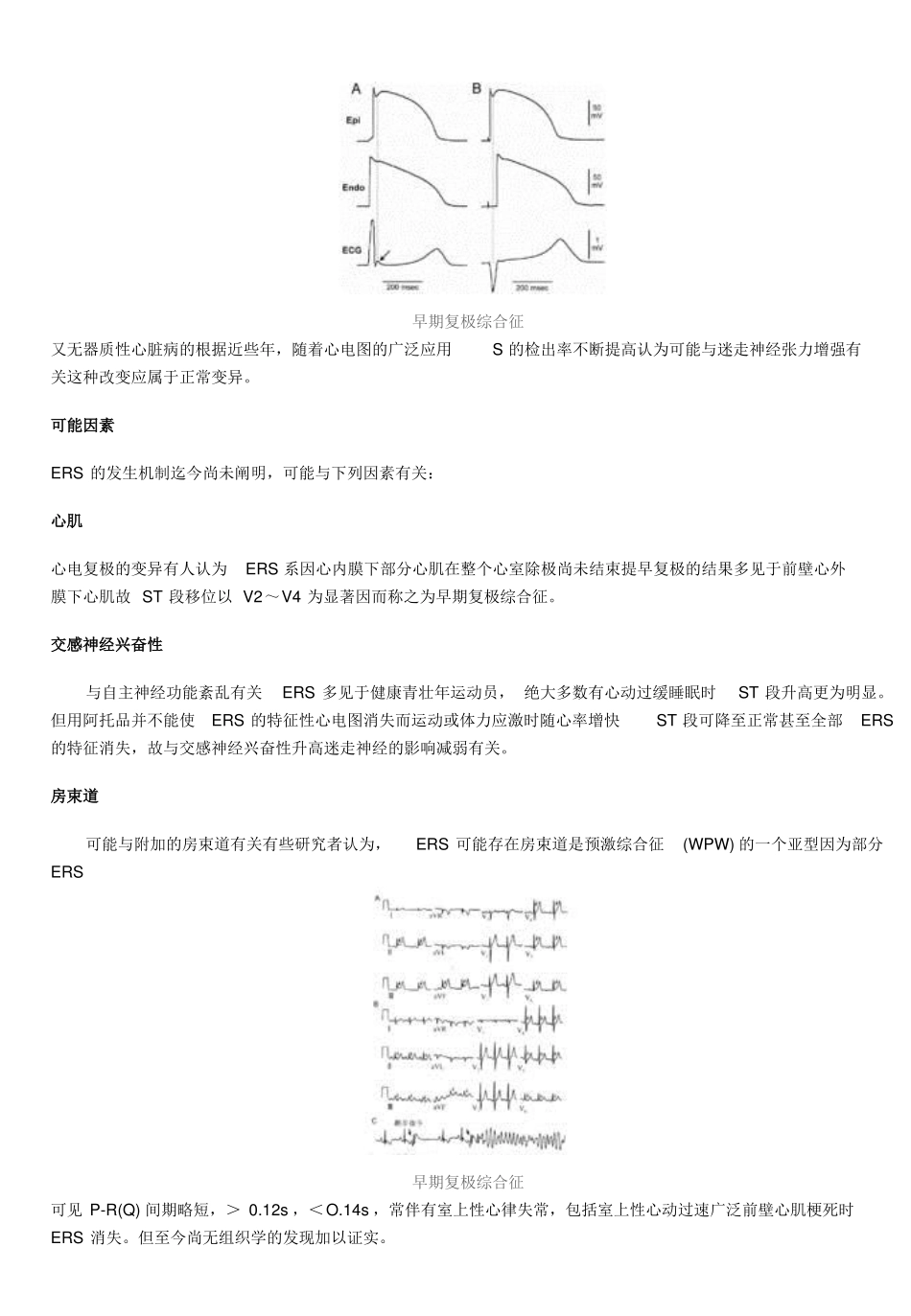 早期复极综合症_第2页