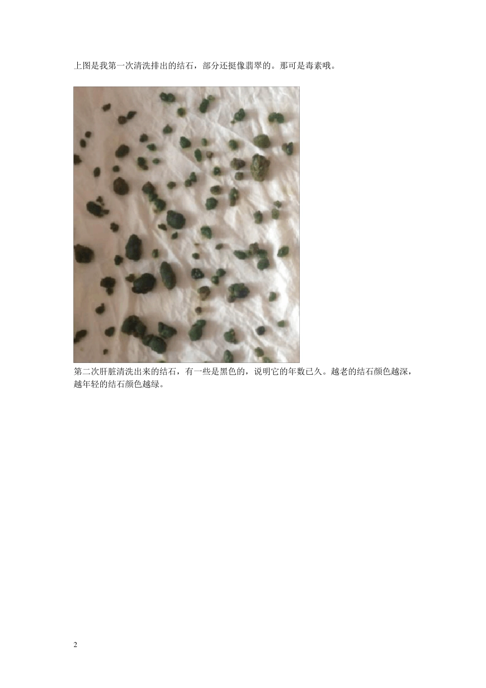 不用动手术无痛苦的肝脏清洗法[排肝胆结石]_第2页