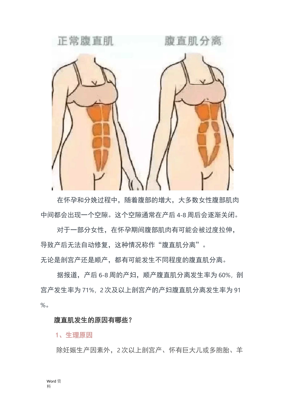 产后康复核心—腹直肌分离与训练方法(有图)_第2页