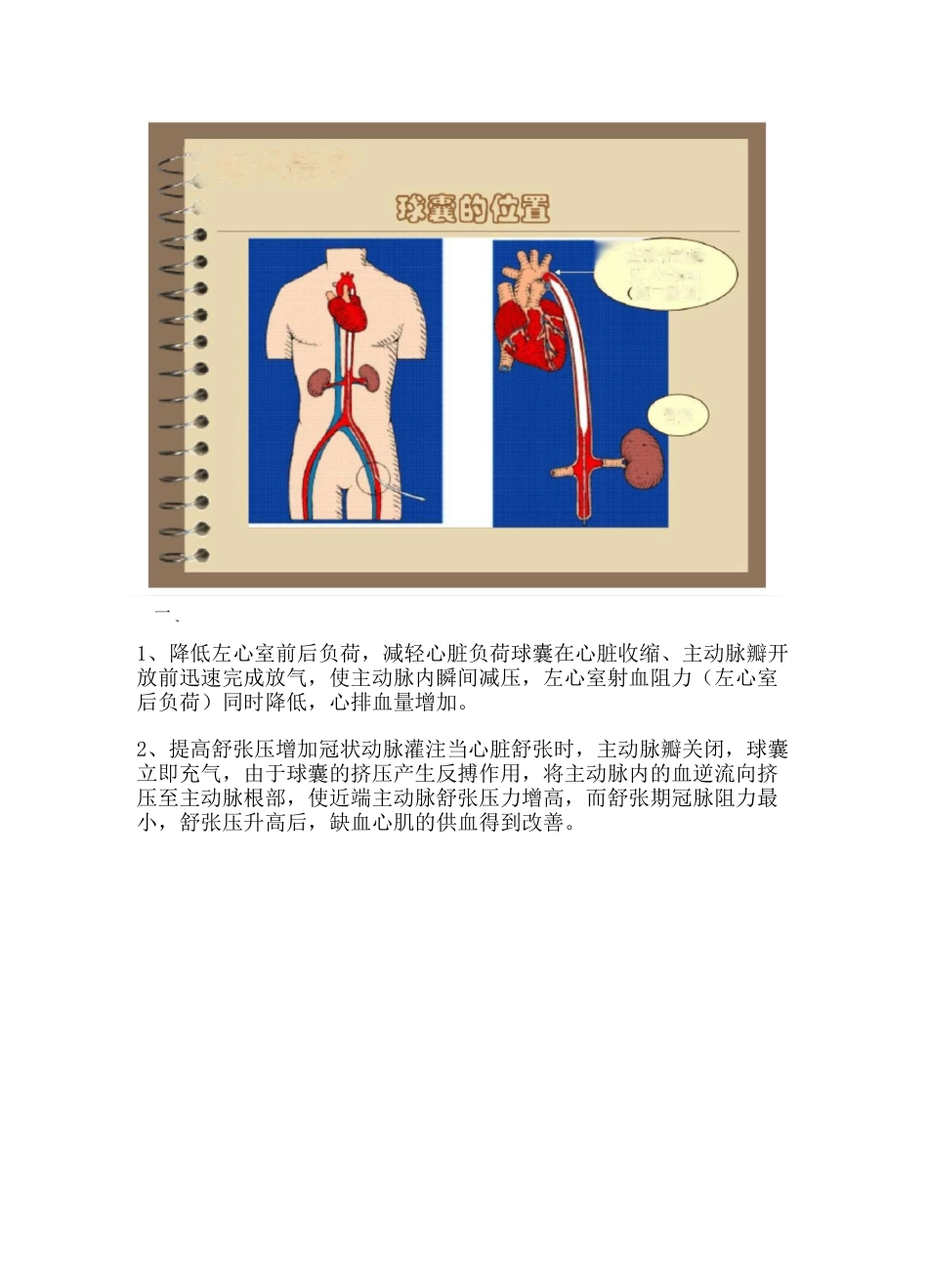 主动脉球囊反搏(IABP)术后护理_第2页