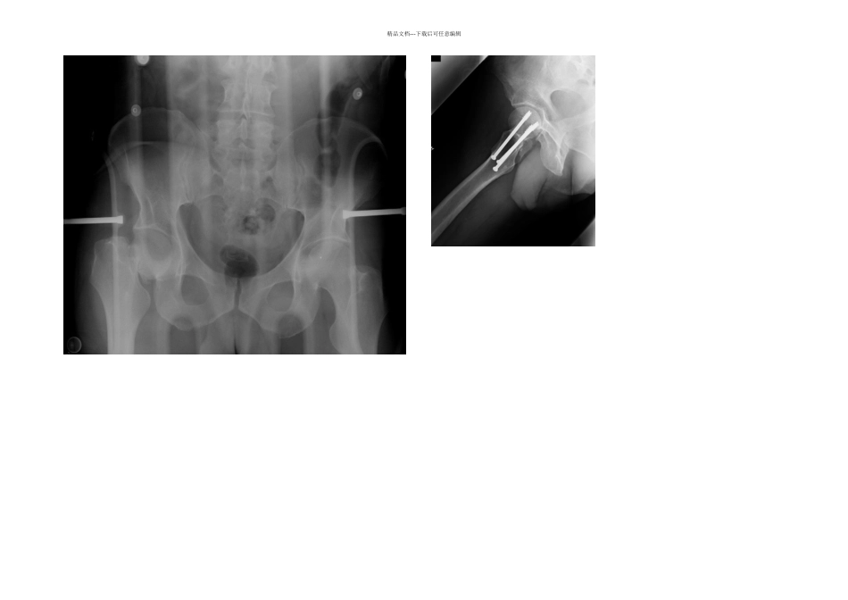 JBJS年轻患者股骨颈骨折的治疗_第3页