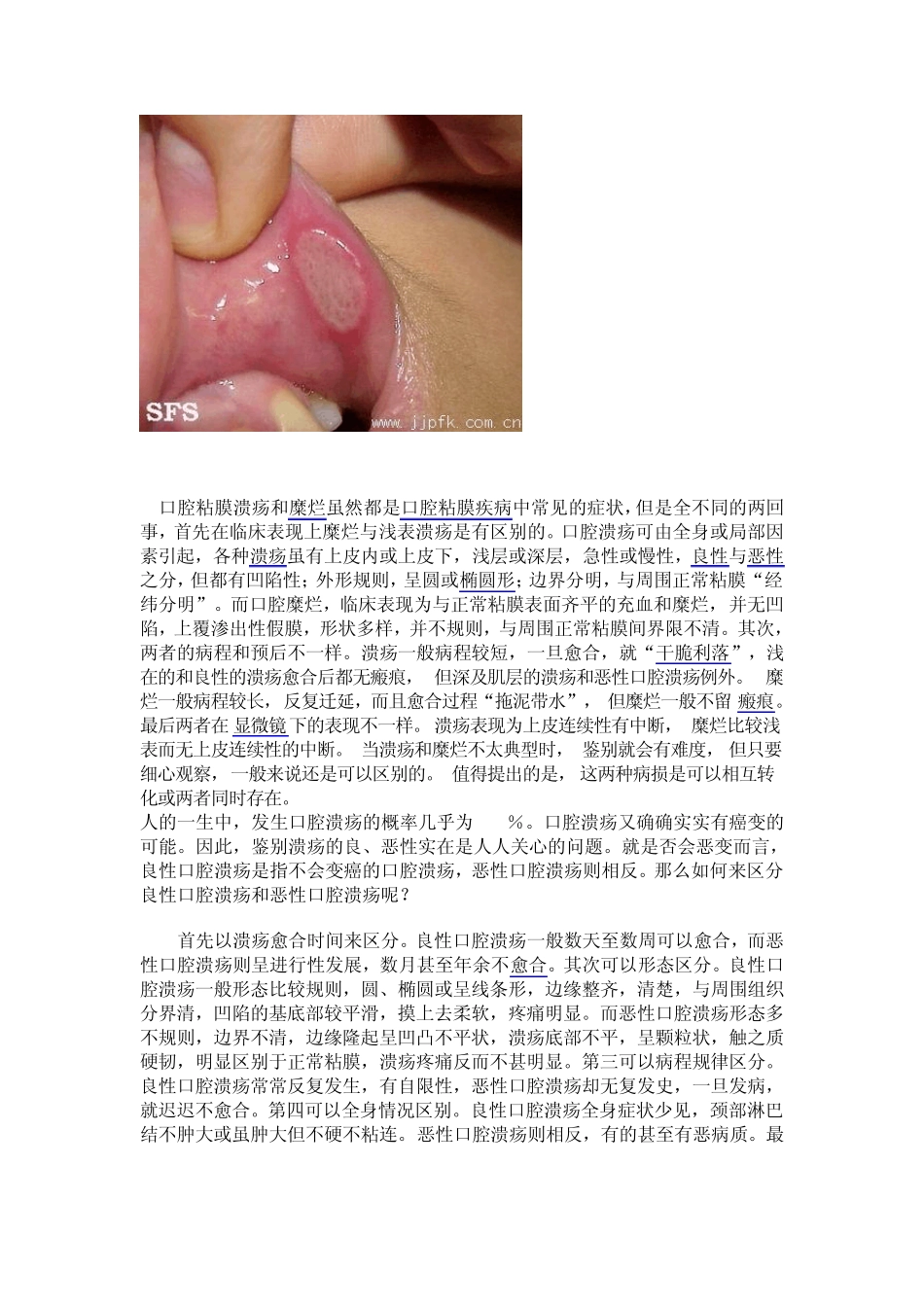 口腔溃疡的治疗方法与预防措施_第2页