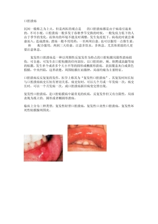 口腔溃疡的治疗方法与预防措施