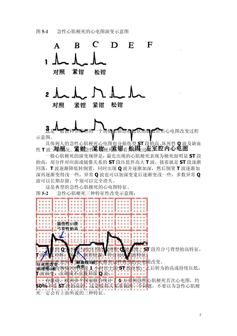 另类心电图讲义13心肌梗死心电图诊断_第2页