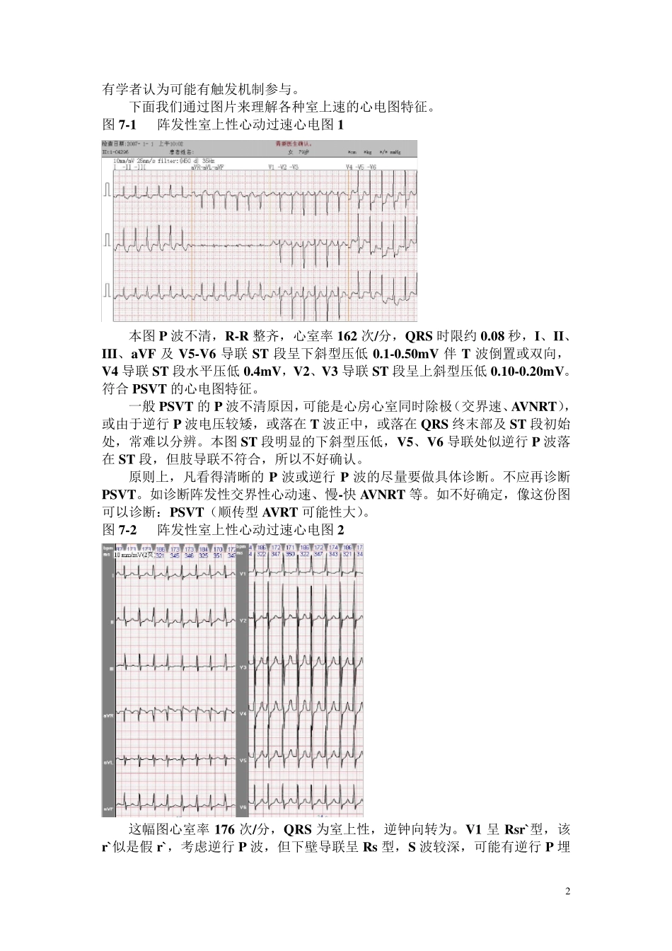 另类心电图讲义7室上性心动过速与折返性心律失常_第2页