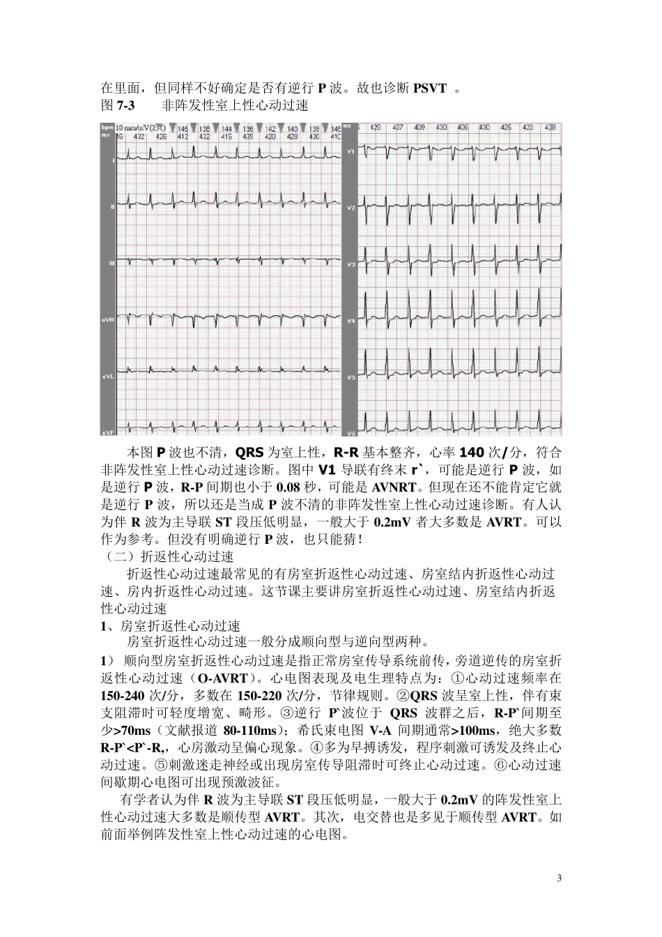 另类心电图讲义7室上性心动过速与折返性心律失常_第3页