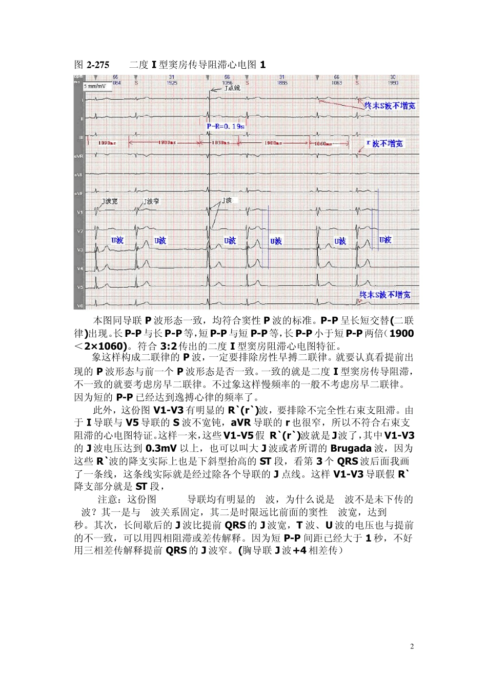 另类心电图讲义9心脏传导阻滞房室传导阻滞_第2页