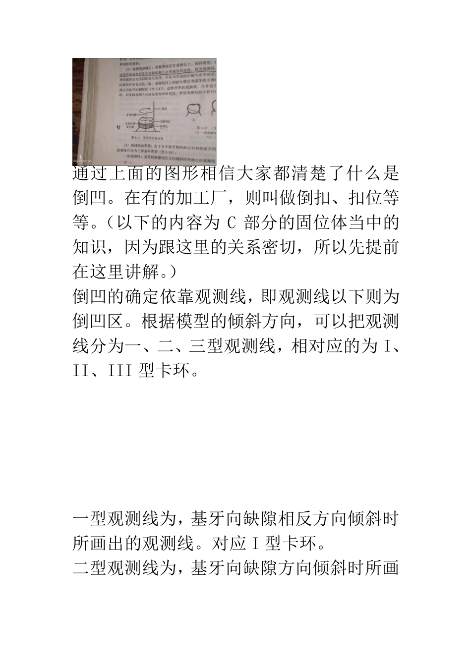 可摘局部义齿的设计方法总结_第3页